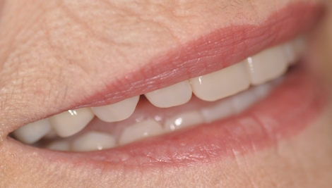 new dentures not false looking teeth